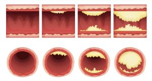 Statine und Cholesterinsenker wirken gegen Arteriosklerose